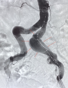 Angiography showing the aneurysm of the left common iliac artery before stentgraft implantation