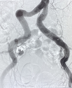 Angiography after treatment - the aneurysm is completely excluded and the stentgraft regular perfused.