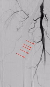 Bild 5 - Mittels Angiographie aus dem Katheter rechts oben im Bild zeigt sich dass nun keine Blutung mehr vorliegt - die Pfeil zeigen auf das verschlossene zuführende Gefäß und die nicht mehr sichtbare Blutung.