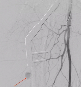 Bild 2 - Angiographische Darstellung der Blutung. Rechts oben im Bild sieht man den Katheter über den Kontrastmittel injiziert wird. Der rote Pfeil zeigt sie aktive Blutung/das Pseudoaneurysma, welches über einen Ast der tiefen Oberschenkelarterie versorgt wird.