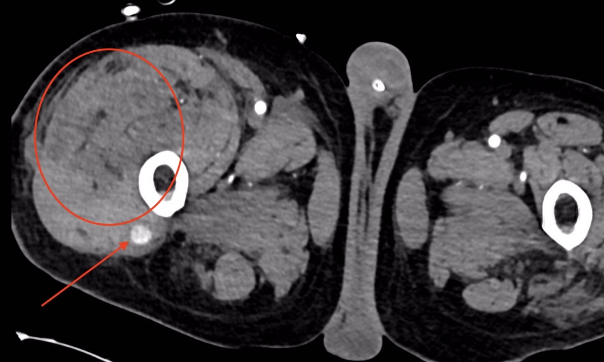 Bild 1 - CT-Untersuchung - Der Pfeil zeigt die aktive Blutung/das Pseudoaneurysma, der Kreis zeigt das massive diffuse Hämatom im Muskel