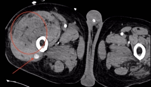 Bild 1 - CT-Untersuchung - Der Pfeil zeigt die aktive Blutung/das Pseudoaneurysma, der Kreis zeigt das massive diffuse Hämatom im Muskel