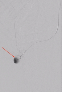 Bild 3 - Man sieht den Mikrokatheter mit 2 Markern sowie wiederum die Blutung (roter Pfeil)