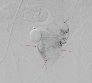Der linke Prostata-Lappen ist mit roten Pfeilen markiert