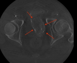 Dyna CT - die der linke Prostata-Lappen ist mit roten Pfeilen markiert