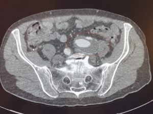 Die Computertomographie der Beckenarterien zeigt das Aneurysma der linken Beckenarterie.