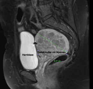 MRT des Unterbauches, Ansicht des Uterus myomatosus von der Seite