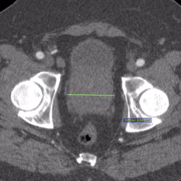pae-vor-embo-ct-axial